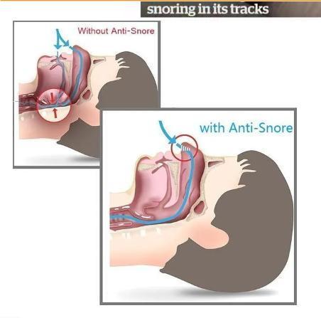 ANTI SNORE DEVICE (Air Purifier)